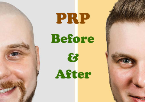 PRP Before and After Safe and Natural Results