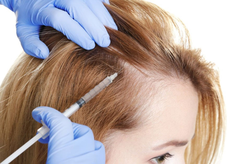PRP Injection Hair Loss
