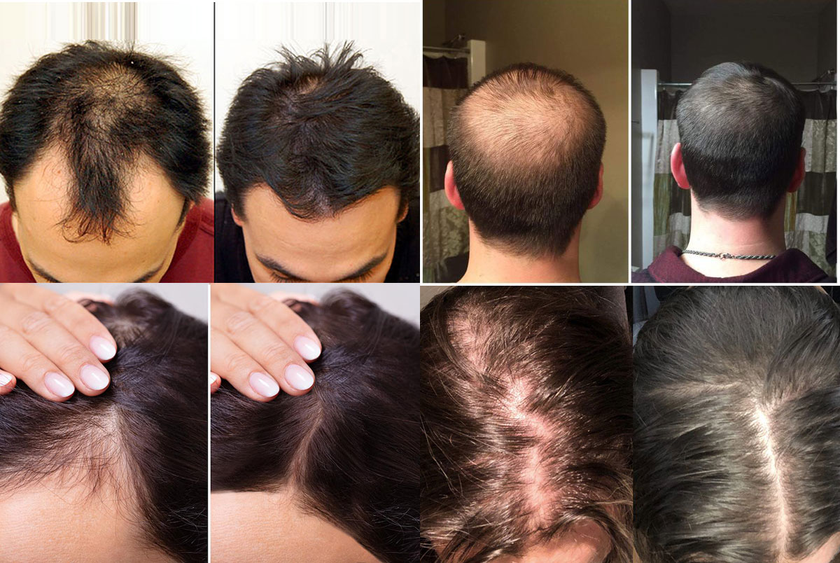 PRP Injection Hair Results Before and After