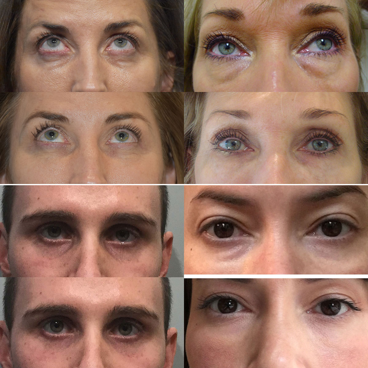 PRP Injection Under Eyes Before and After